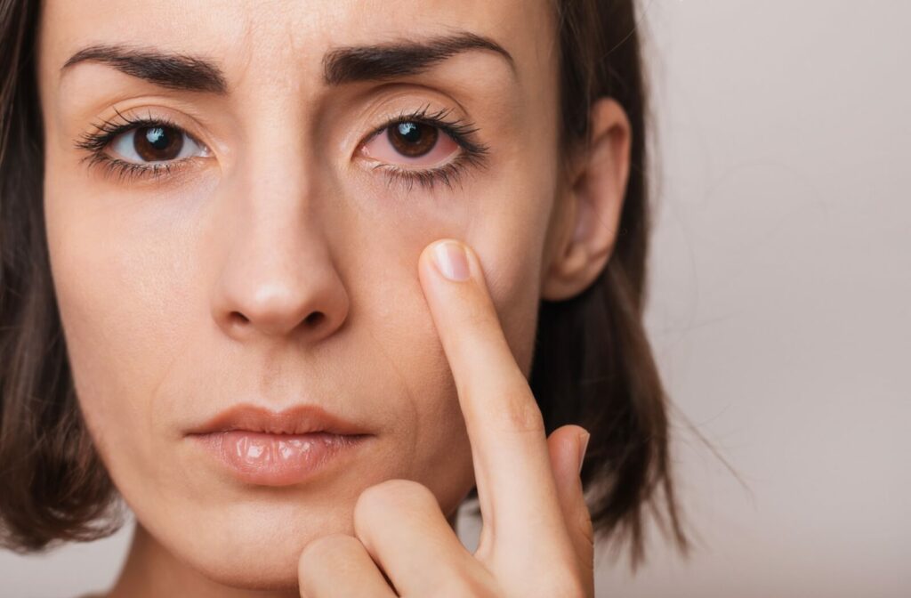 A patient pointing at their irritated, pink eye.