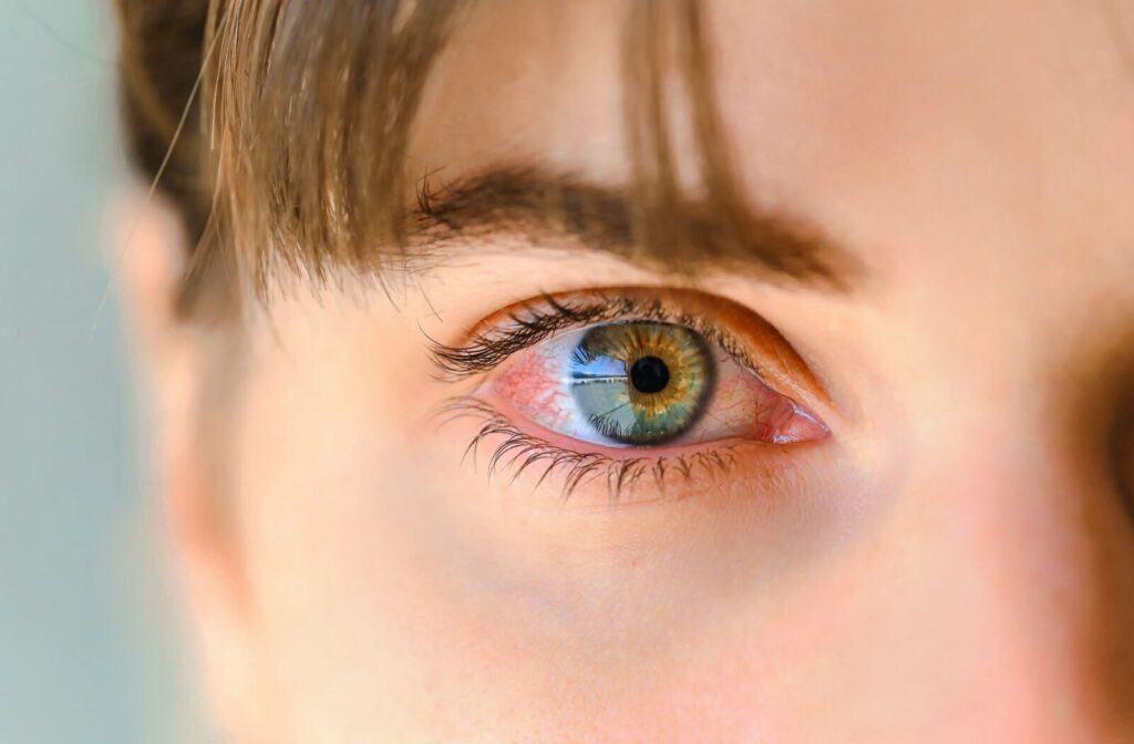 Closeup of a persons red eye.
